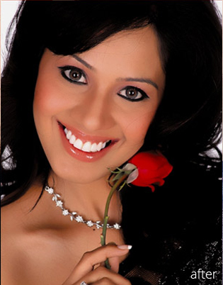 Smile Makeover In Delhi, Dental Clinic In Delhi