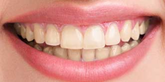 Smile Makeover In South Delhi