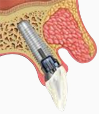 dental implant in South Delhi, dental implant in Delhi