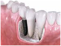 dental implant in Delhi, Dentist in Delhi