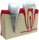 Dental implant clinic in Delhi, dental implant in South Delhi
